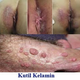 Illustration for article titled Obat Menghilangkan Kutil Di Bibir Vagina
